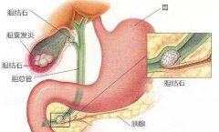 胆囊结石的症状是什么？