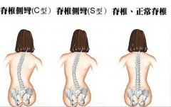 脊柱侧弯的常见症状有哪些？