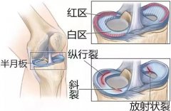 膝关节半月板损伤的临床表现